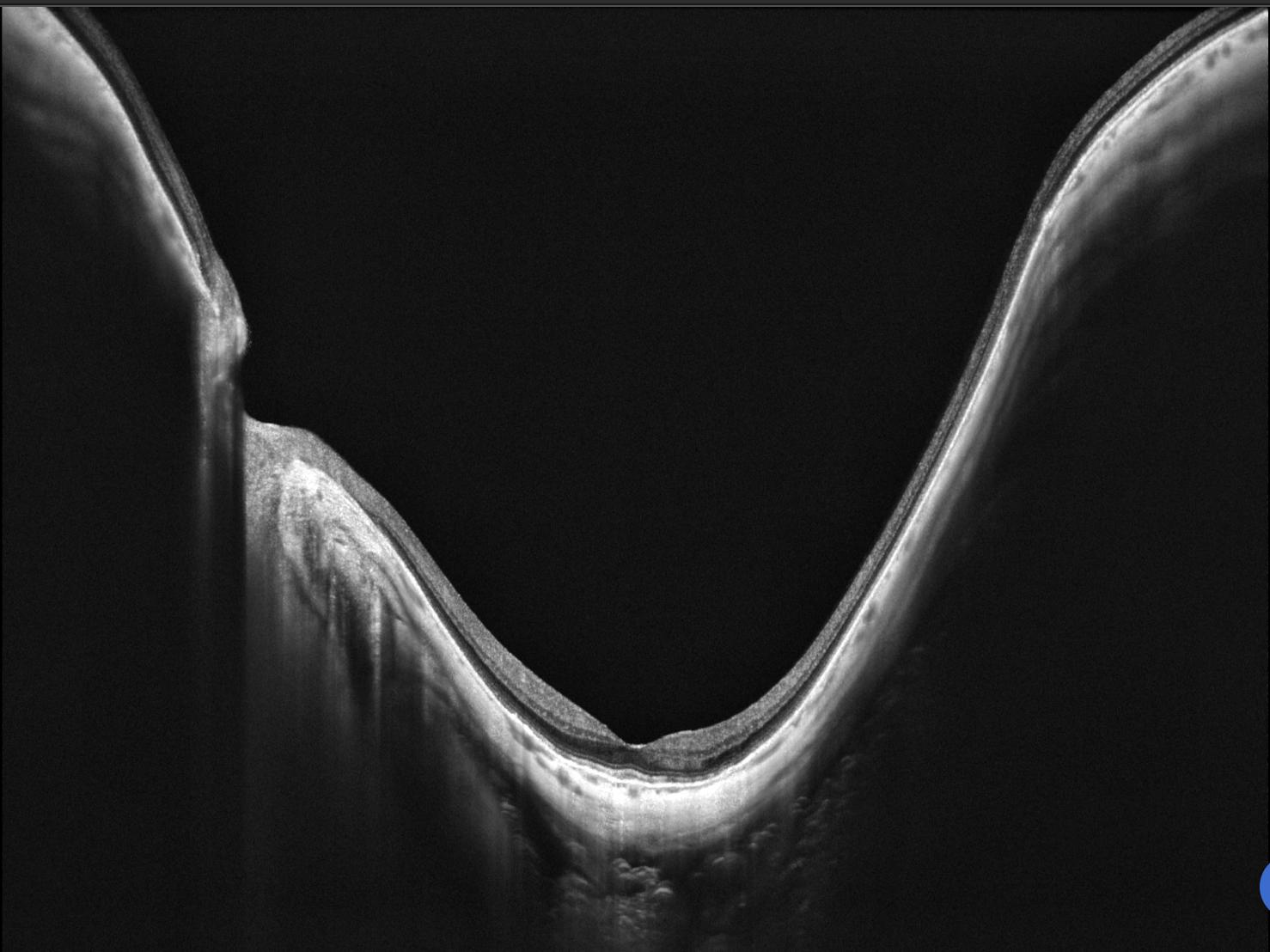 OCT Intalight montrant un staphylome myopique fovéolaire